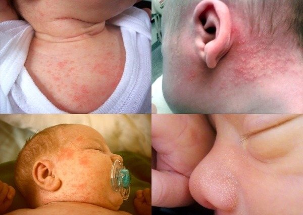 Акне у новорожденных. Признаки, как выглядит, фото на лице, голове, груди, спине. Как отличить от аллергии, чем лечить, мази, народные средства, уход за кожей ребенка