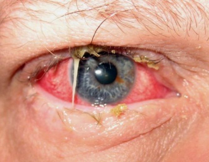 bacterial conjunctivitis in adults photo