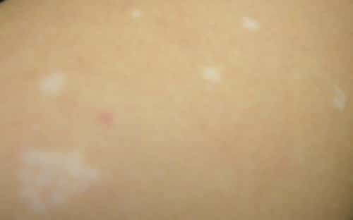 White spots on the skin