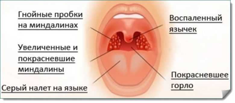 Чем лечить красное горло у детей
