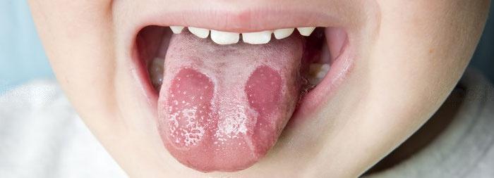 Чем лечить стоматит на языке у ребенка. Нервным фото не смотреть