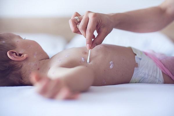 How to treat chickenpox in children, except brilliant green: modern and effective methods