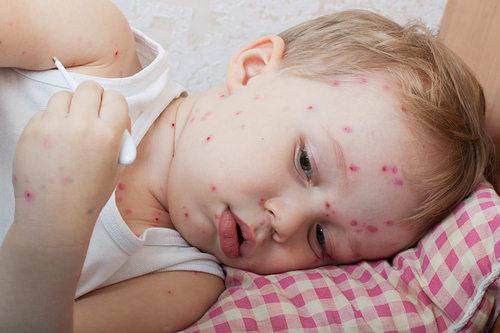 How to treat chickenpox in children, except brilliant green: modern and effective methods