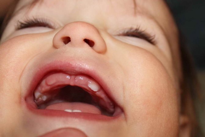 десна при прорезывании зубов у детей