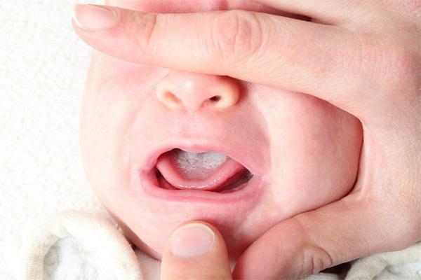 Photo of thrush in a baby&#39;s mouth