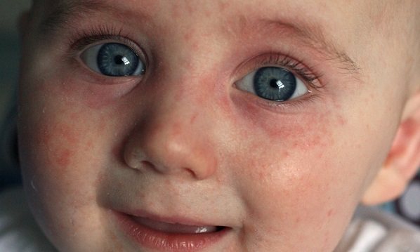 Photo of a child with a meat allergy