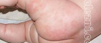 Фото с симптомами пеленочного дерматита и его лечение