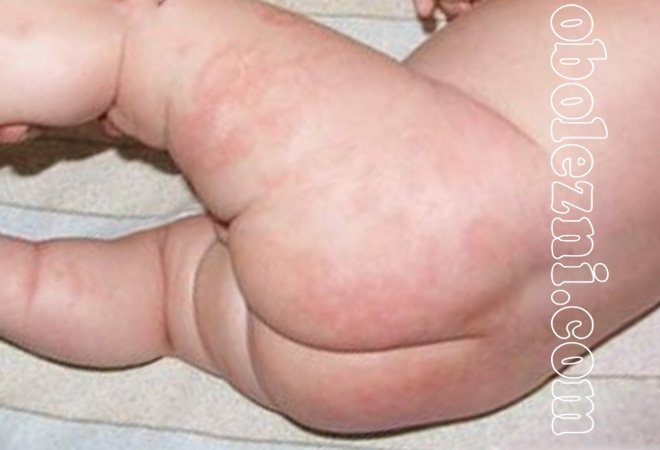 Фото с симптомами пеленочного дерматита и его лечение