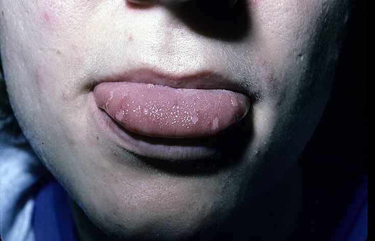 Photo of chickenpox in a patient&#39;s mouth
