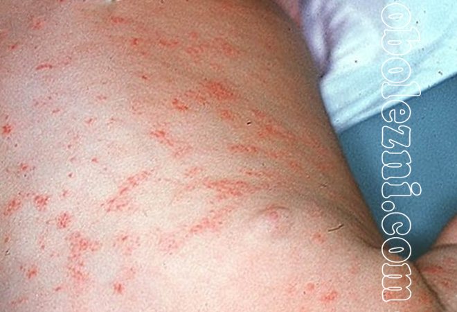 Фотографии с симптомами грибкового пеленочного дерматита