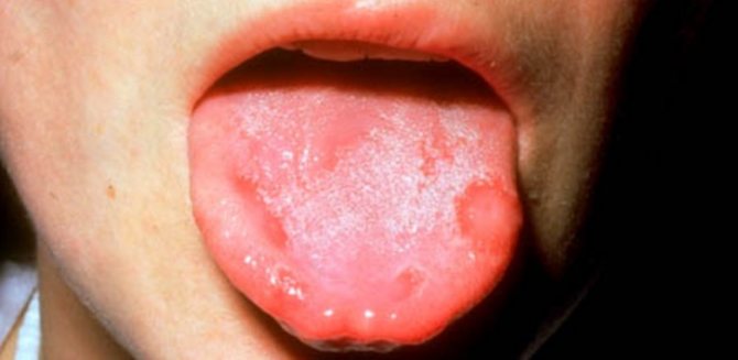Герпетический стоматит: виды и симптомы проявления на языке и деснах ...
