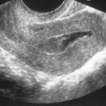 Гибель эмбриона на ранних сроках