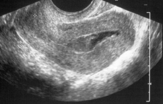 Гибель эмбриона на ранних сроках