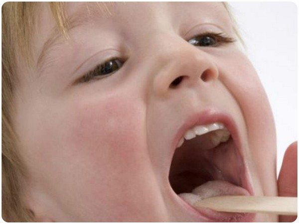 A child&#39;s throat with sore throat