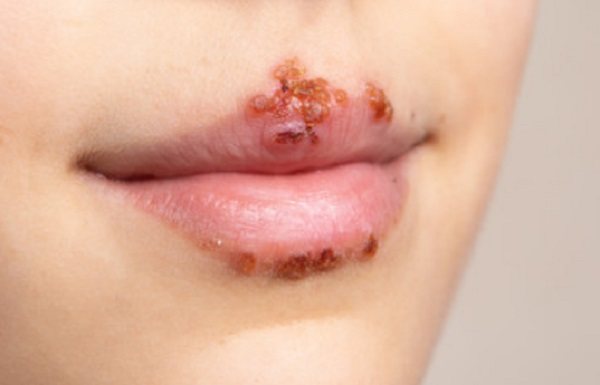 Lips of a child with herpes