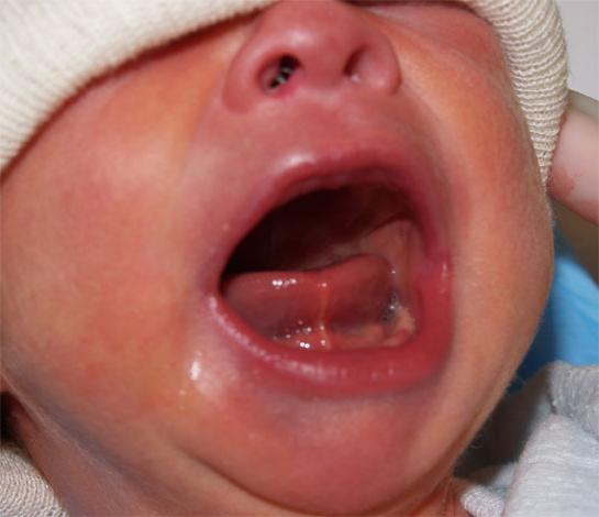 red throat in a baby: causes