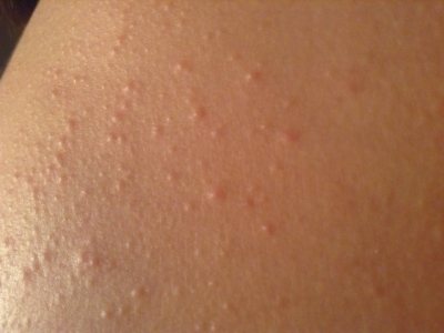 Red pimples