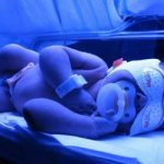 лечение желтушки у новорожденных
