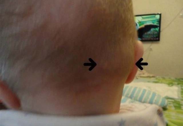 Lymphadenitis on the back of the head in a child