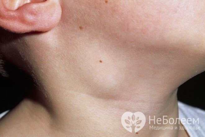 Lymphadenitis in children often occurs with inflammation of the upper respiratory tract