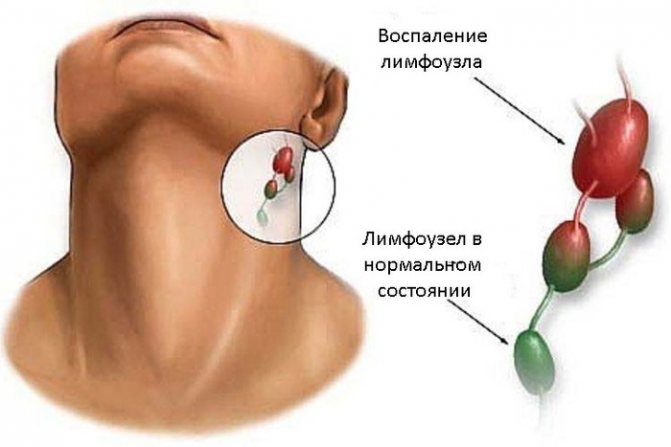 Lymph nodes on the head. Location, diagram, photo, where they are. Symptoms of inflammation, treatment 