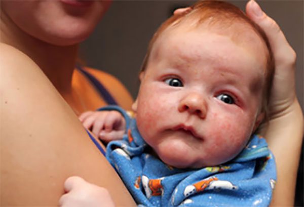 Baby with childhood eczema