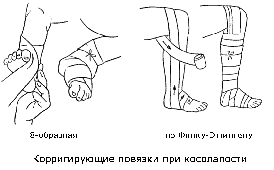 Soft bandages for club feet