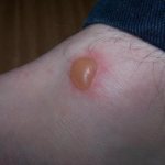 blisters appeared on the leg