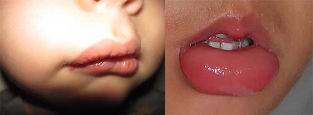 Опухшие губы у детей
