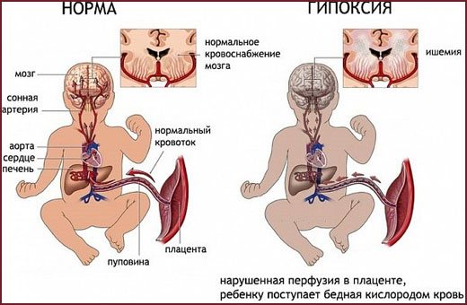 Последствия гипоксии у новорожденного при родах, нарушения психического развития. Лечение