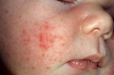 heat rash or allergies how to distinguish in adults