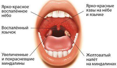 Signs of a sore throat