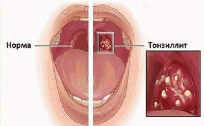 Signs of tonsillitis