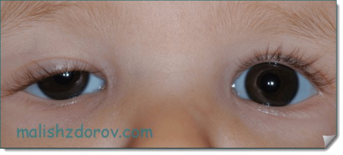 Ptosis in a child