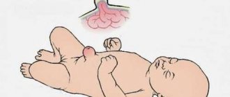 An umbilical hernia in a newborn baby is a protrusion in the umbilical ring, which can take on different sizes.