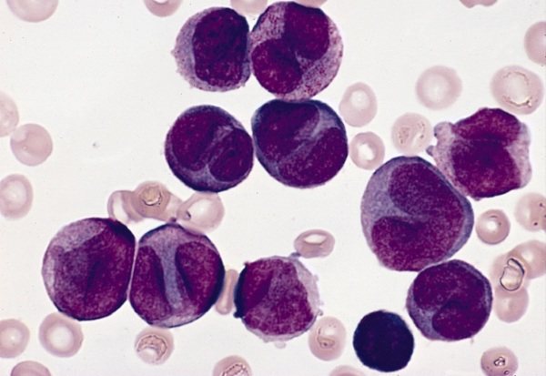 Reactive lymphocytes are elevated in children and adults. What does this mean, reasons, how to treat 