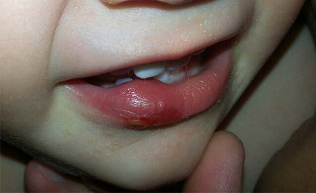 The child bit his lower lip