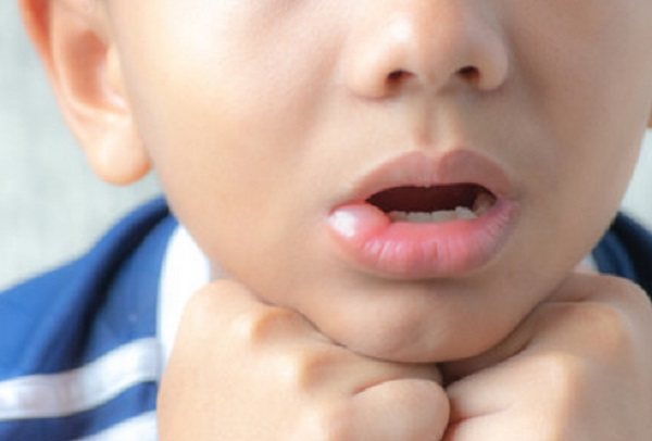 Child with swollen lip