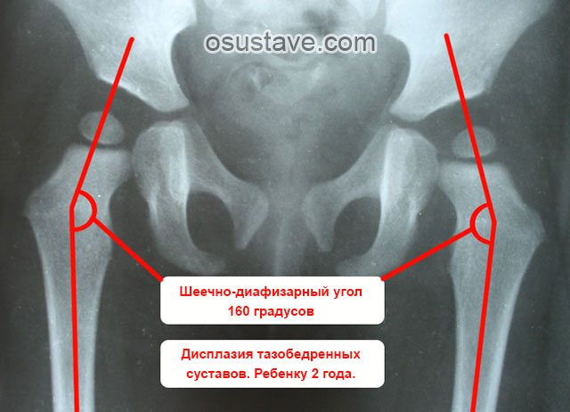 рентгенография тазобедренных суставов