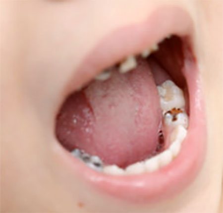 Ротовая полость ребенка, на зубе кариес