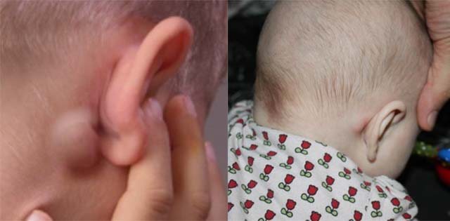 Lump behind a child&#39;s ear