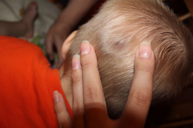 Шишки на голове у детей – частое явление