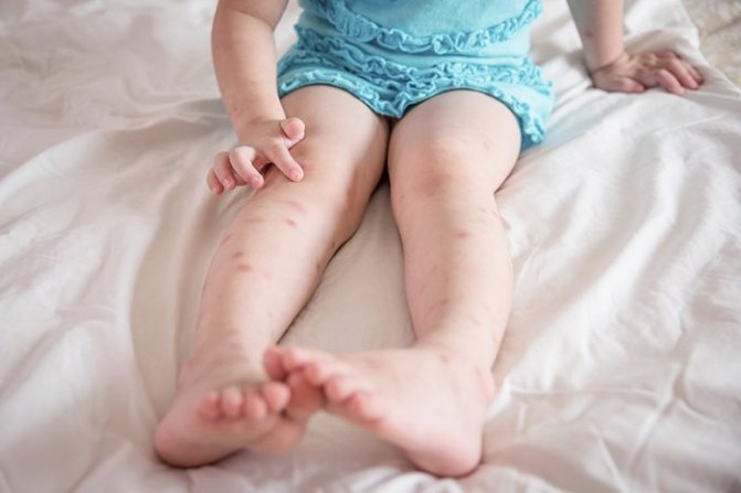 следы от укусов комаров на ногах у ребенка