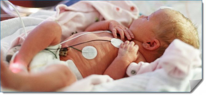 Степени недоношенности новорожденных