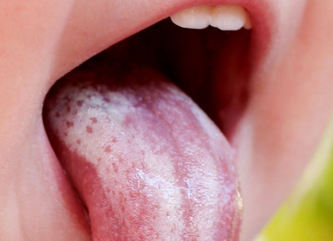 Stomatitis as a cause of ulcers on a child’s tongue
