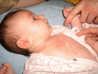 Сыпь на теле у ребенка после высокой температуры фото