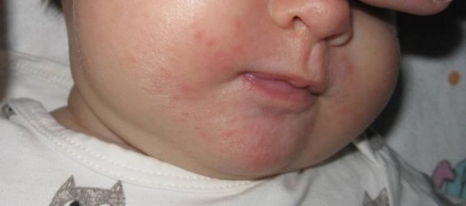 Сыпь вокруг рта у ребенка. Причины 2-3, 5-6 лет, чем лечить, что советует Комаровский