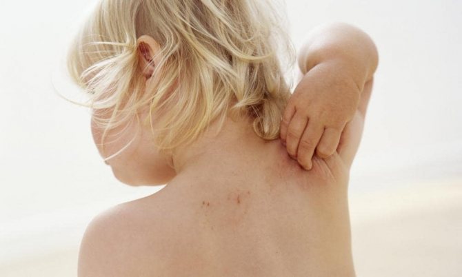 a child has a rash on his back, how to recognize the disease