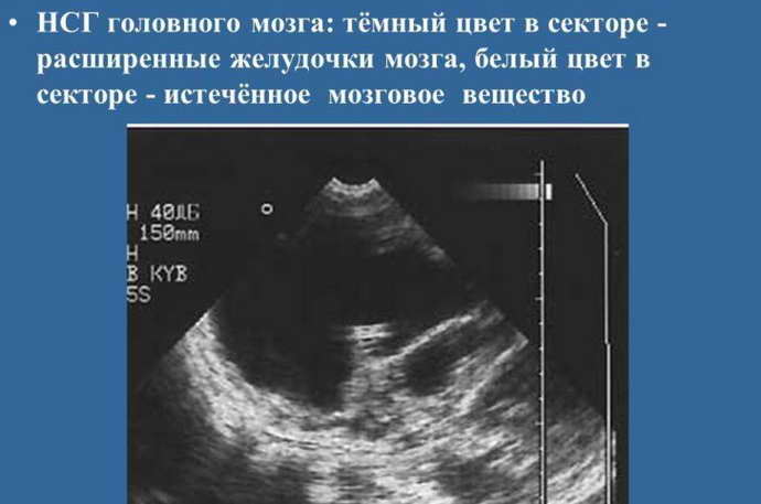 Ultrasound of the brain in a baby interpretation