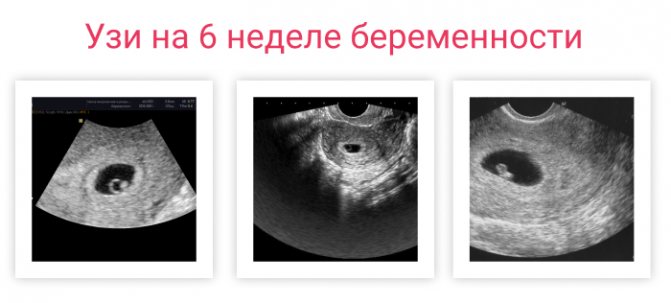ultrasound at 6 weeks pregnant